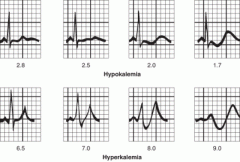 Arrhythmias- on ECG you may see T wave flattening at first. If it is severe you may see T-wave inversion and appearance of U-waves