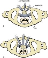 The disruption of the transverse axial ligament (TAL) with intact alar ligaments results in C1-C2 instability without cord compression

That is why the alar ligaments are called the "check" ligaments