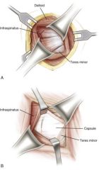 Infraspinatus (suprascapular nerve) and teres minor (axillary nerve). To access this interval the posterior deltoid must be split.
