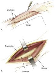 Distal approach: between the biceps (musculocutaneous) and brachialis (musculocutaneous/radial) laterally, or the brachialis can be split because of its dual innervation.

The radial and axillary nerves could be at risk mostly due to traction