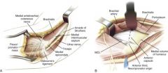 Between the brachialis (musculocutaneous) and pronator teres (median nerve) distally.

Risks: The ulnar and medial antebrachial cutaneous nerves are in the field and must be protected