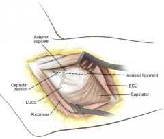 Interval: between the anconeus (radial nerve) and the origin of the main extensor (extensor carpi ulnaris, posterior interosseous nerve [PIN]). 

Dissection: Pronate the arm to move the PIN anteriorly and radially, and approach the radial head through t