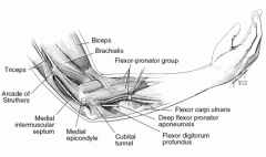 1. Arcade of Struthers
2. Medial intermuscular septum
3. Medial epicondyle
4. Cubital tunnel
5. Proximal edge of FCU (Osborne fascia)
6. Deep flexor pronator aponeurosis