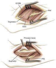 Extensor Carpi Radialis Brevis (radial nerve) and Extensor Digitorum Communis (PIN). 
Distally: Extensor pollicis longus

Structures at risk: PIN, you must avoid excessive retraction of the supinator