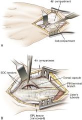 Between the third and fourth extensor compartments (EPL and EDC)

The interosseous scapholunate ligament can be violated