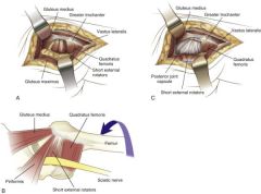 Splitting the fibers of the gluteus maximus

Dissection:
  	□   	Incise the skin and the fascia lata along the posterior border of the femur, and then split the fibers of the gluteus maximus bluntly.
  	□   	Expose the short external rotators close to