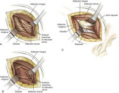 Superficial: Between adductor longus and gracilis
Deep: Adductor brevis and adductor magnus