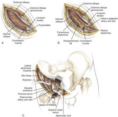 Ilioinguinal approach, it relies on mobilization of the rectus abdominis and iliacus