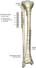 1. Neutral position
2. Compression on opposite side of the fracture
3. Lag screw (if placing through plate)