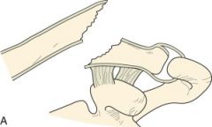 What is the most common location for a clavicle fracture?