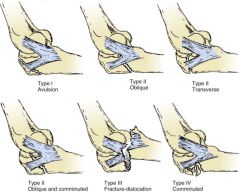 Colton Classification:
Type I: Avulsion
Type II (A-D): Oblique fractures with increasing complexity
Type III: Fracture-dislocations
Type IV: Atypical high-energy multifragmented fractures