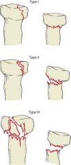 Type I - Nondisplaced (splint for no more than 7 days then allow motion)

Type II - Partial articulation with displacement (Nonsurgical, pain mgmt & active ROM if elbow is stable & no block to motion with good reduction; otherwise ORIF)

Type III - Co