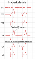 1. Arrhythmias- the most important effect of hyperkalemia is on the heart. Check an ECG immedicately. With increasing potassium, ECG changes progress through tall, peaked T waves, QRS widening, PR prolongation, loss of p waves and finally a sine w...