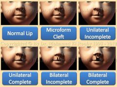 1) Microform cleft

2) Incomplete cleft

3) Complete cleft