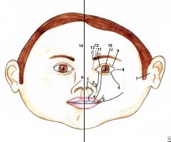 Clefts may involve the mouth, cheeks, eyes, ears and forehead and may continue into the hairline. These craniofacial clefts are often referred to as Tessier clefts. 

They are numbered from 0-14 to indicate the location and extent of the cleft u...