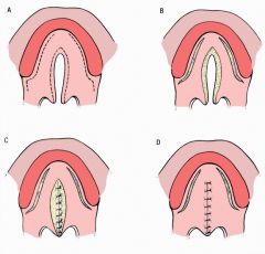 Attached anteriorly & posteriorly
Blood supply from both anterior & posterior attachments
Blinded dissection around the greater palatine artery pedicles.
Shortens palatal length
Used for more narrow clefts
Single staged