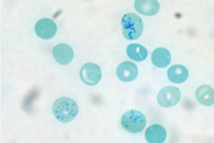 The patient's perpheral blood smear shown in the image includes RBCs that are smaller than normal with a bluish tinit and a lack of central pallor, in addition to some larger, immature RBCs.


 


Which of the following diseases is most likel...