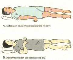 *Decorticate: abnormal flexion (turning inward)
*Decerebrate: abnormal extension (turning outward)