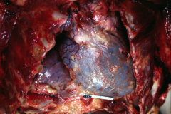 *HEMOPERICARDIUM, autopsy specimen.
*Pericardial sac is tense and bluish looking (from all the blood inside it.
