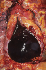 *HEMOPERICARDIUM.
*Opened sac; blood is clotted and completely surrounds the heart.
*This was cardiac tamponade (rapid onset).