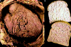 *Fibrinous Pericarditis.
*Pericardium has been opened.
*Fibrous material also on the parietal pericardium.
*Known as "bread and butter" pericarditis.