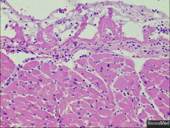 *FIBRINOUS PERICARDITIS.
*Fibrin and an inflammatory reaction.
*With time there is resolution or scarring.
*Note the pink fibrin sitting on top of the epicardium, with some inflammatory cells and loose fibers at the top.