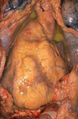 *Suppurative Pericarditis.
*Probably a smoker.
*Note pools of green/yellow pus.