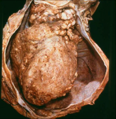 *Caseous Pericarditis due to TB.
*Nodules on heart represent granulomatous inflammation.