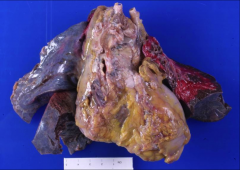 *CONSTRICTIVE PERICARDITIS. Adhesive pericardium following 3 previous cardiac surgical procedures.
*Heart is distorted due to being embedded in fibrous tissue. Darker tissue is staining from lymph nodes.