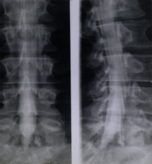 A) Angiv hvilken røntgendiagnostiskundersøgelse der er vist på billederne.


B)  Benævndet rum omkring medullaspinalisog caudaequinahvor der er injiceret kontrastvæske.