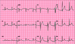 EKG findings in Pericarditis
1) Note that the elevations are NOT LOCALIZED. Means this is not an MI.
2) Contour of the ST segment is upcoving (here, especially V2, V3, V4) in pericarditis. In an MI it is DOWNcoving.