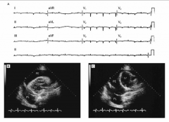 *CXR:  “water bottle” shaped heart.

*EKG:
1) low voltage.
2) “electrical alternans” (small and large QRSs).

*Echocardiogram shows fluid ("PE").