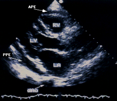 *Cardiac Tamponade!

*Fluid under high pressure compresses the cardiac chambers:	
1) acutely: trauma, LV rupture – may not be very large.
2) gradually: large effusion, due to any etiology of acute pericarditis.