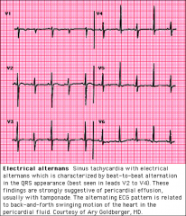 *EKG: low voltage, sinus tachycardia, electrical alternans.

*Echocardiography:
1) pericardial effusion (r/o other etiologies in dif dx).
2) RA and RV diastolic collapse.