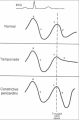 *a wave: atrial contraction

*v wave: passive filling of atria during 
   ventricular systole with mv/tv closed

*y descent: early atrial emptying with mv/tv
   open (early passive filling of ventricle)

*Tamponade:
-blunted y descent (im...