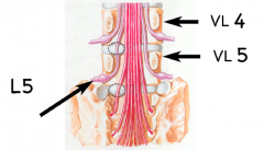 Spinalnerverod L5.


Pga. de lumbale nerverødders forløb ned og lateralt, vil en discusprolaps ofte trykke på spinalnerverødderne i det underliggende segment.