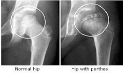 - Idiopathic osteonecrosis of the capital femoral epiphysis (growth plate) of the femoral head. 
- Insidious onset. Child does not complain.
- 1-1200 children
- Hip/Groin pain, referred to thigh.