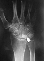 - Avascular necrosis of the carpal lunate.
- age 20-40
- Pain and disability
- Treated surgically