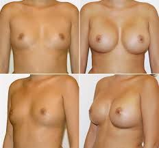 while stepping in adolescence some girls body parts dose not develop properly due to some reasons Married women breasts become shapeless, loose and non-graceful due to ,breast feeding and luck of proper care, necessary vitamins and minerals in the...