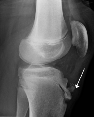 - Common cause of knee pain.
- Micro-fractures in area where the patellar tendon inserts into the tibial tubercle.
- Bony bump on the tibial tuberosity.