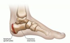 - AKA:Calcaneal Apophysitis 
- Inflammation in the growth plate of children.
- Heel
- Due to repetitive stress