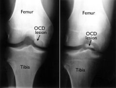 - Bone/cartilage inflammation.
- Loss of blood supply to an area of bone beneath the surface of a joint. *Knee* common