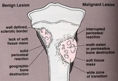 - Well-demarkated edges.
- Sharpey's fibers attach periosteum to bone. Very painful.
- Ex: Osteoma...