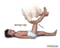 One of the physically demonstrable symptoms of meningitis; severe stiffness of the hamstrings causes an inability to straighten the leg when the hip is flexed to 90 degrees
