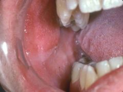a child has fever and those marks opposite to the molars, what is this pathology