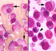 Bone marrow aspirate:
Identify the cells on the left.
Identify the cells on the right.
Dx of either patient?
