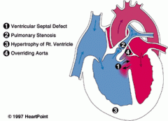 1. Pulmonary Stenosis
2. Right Ventricular Hypertrophy (secondary pulm stenosis)
3. Overriding Aorta
4. Ventricular Septal Defect (VSD)