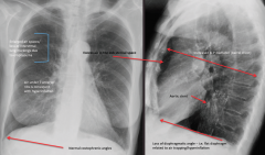 "Hyperinflation

7 ribs visible anteriorly, loss of interstitial lung markings, increased AP diameter, flattening of the diaphragms, air in retro sternal area.

Bonus: Aortic stent"