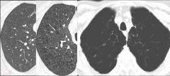 L to R: Normal lung, mild/moderate emphysema, severe emphysema.