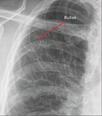 "Severe bollus emphysema.

Some scoliosis, upper lobes are missing lung tissue, a bunch of bollae are visible."